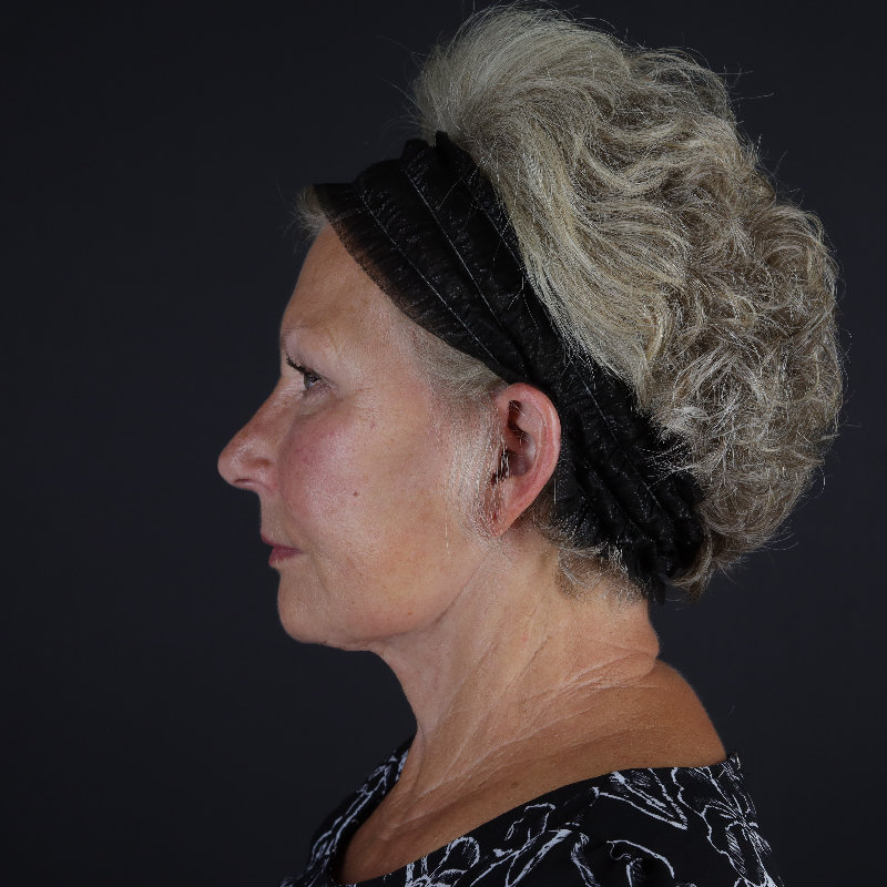 Facelift Before & After Image