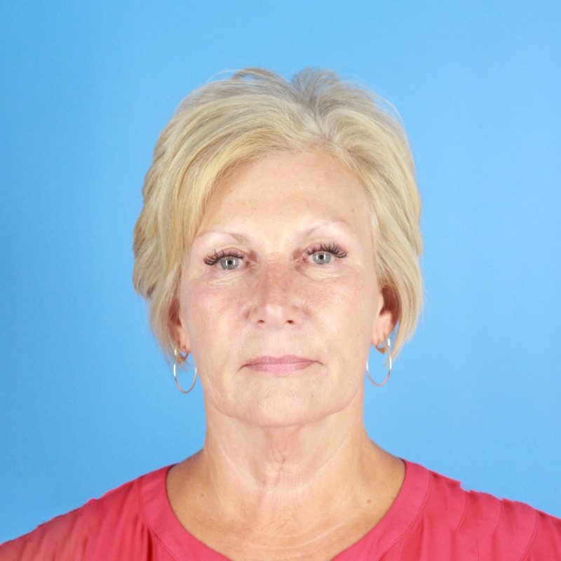 Facelift Before & After Image