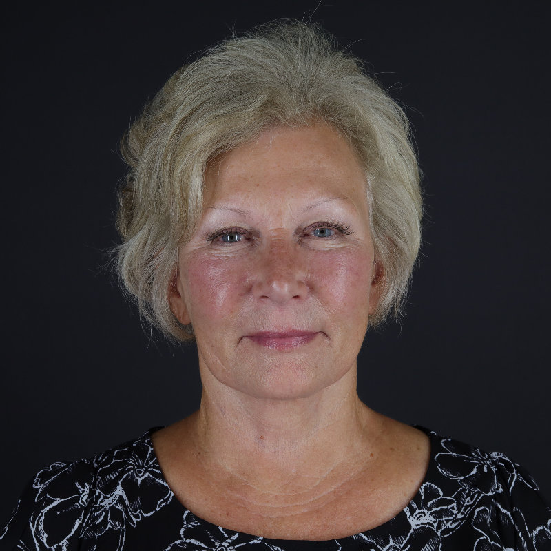 Facelift Before & After Image