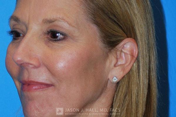 Facial Rejuvenation Before & After Image