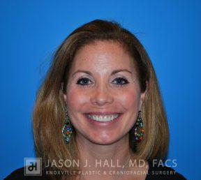 Facial Rejuvenation Before & After Image