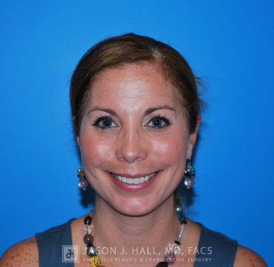 Facial Rejuvenation Before & After Image