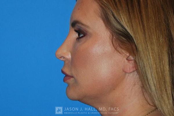 Facial Rejuvenation Before & After Image