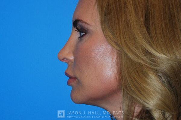 Facial Rejuvenation Before & After Image