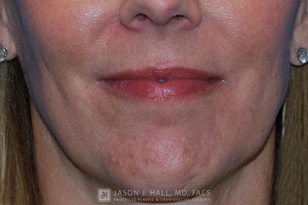 Facial Rejuvenation Before & After Image