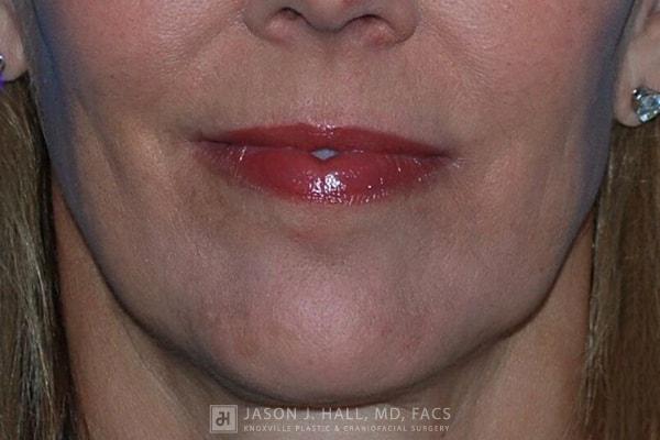 Facial Rejuvenation Before & After Image