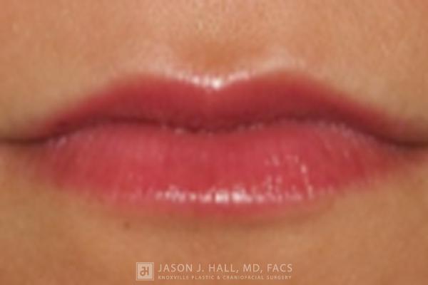 Facial Rejuvenation Before & After Image