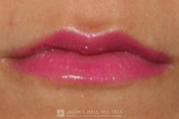 Facial Rejuvenation Before & After Image