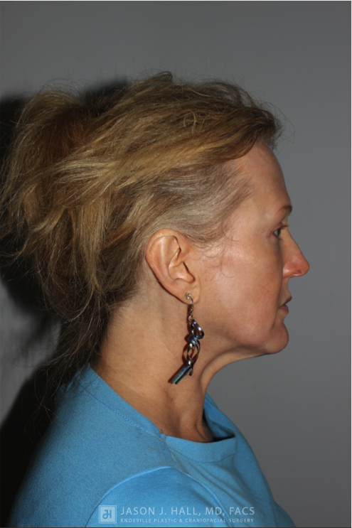 Facial Rejuvenation Before & After Image