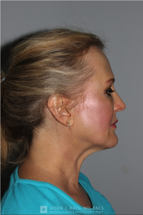 Facial Rejuvenation Before & After Image