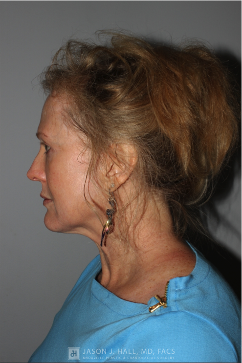 Facial Rejuvenation Before & After Image