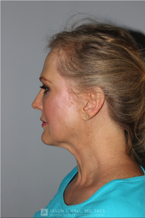Facial Rejuvenation Before & After Image