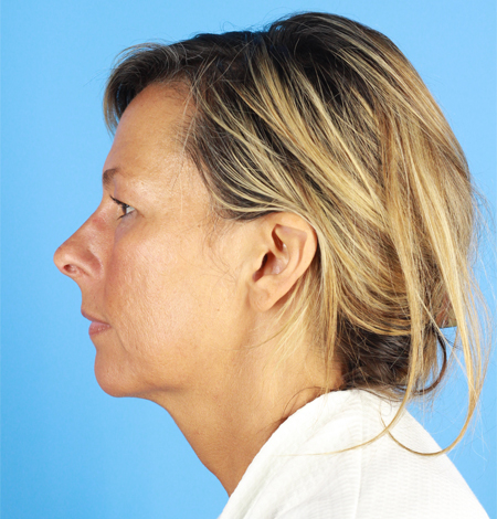 Facial Fat Grafting Before & After Image