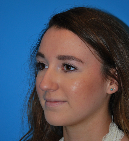Rhinoplasty Before & After Image