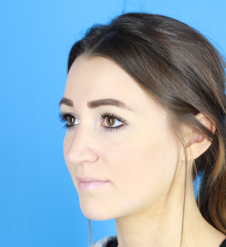 Rhinoplasty Before & After Image