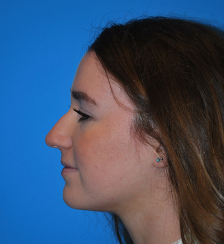 Rhinoplasty Before & After Image