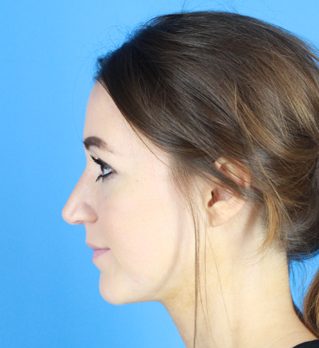 Rhinoplasty Before & After Image
