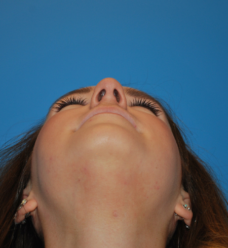 Rhinoplasty Before & After Image