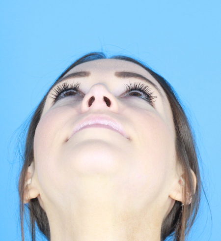 Rhinoplasty Before & After Image