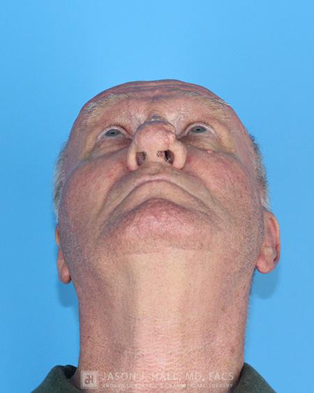 Rhinoplasty Before & After Image